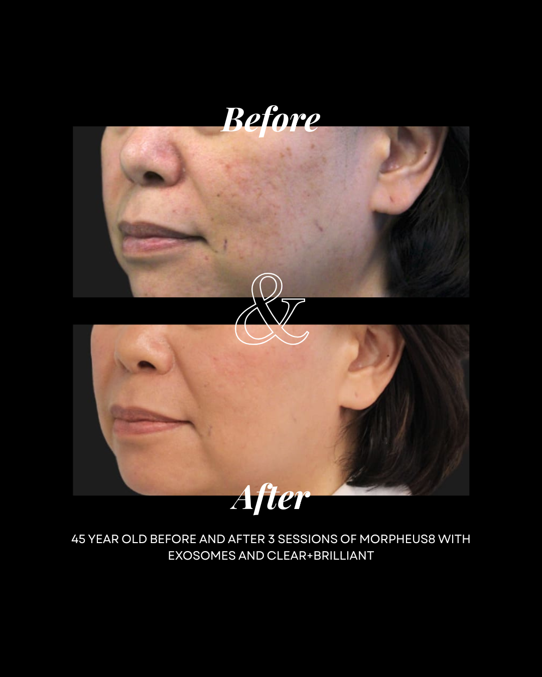 MORPHEUS8 FACE & NECK COLLECTION