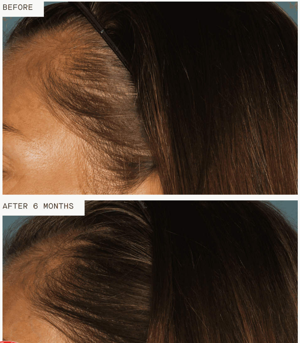 Nutrafol Postpartum Hair Growth Pack