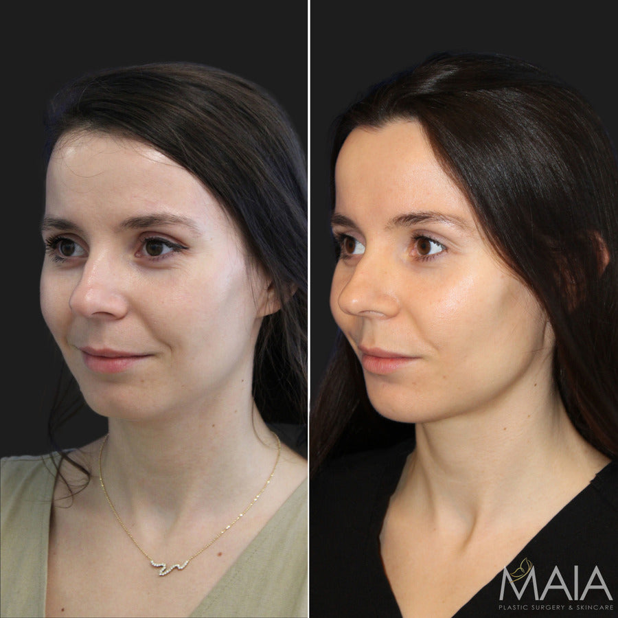 Bank Your Filler with Dr. Maia - Feb 9th to 14th ONLY