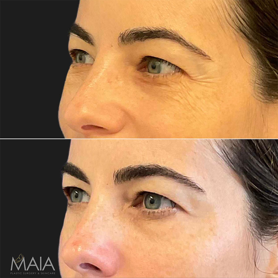Unit of BOTOX - Bank Your Botox with Dr. Maia -Feb 9th to 14th ONLY