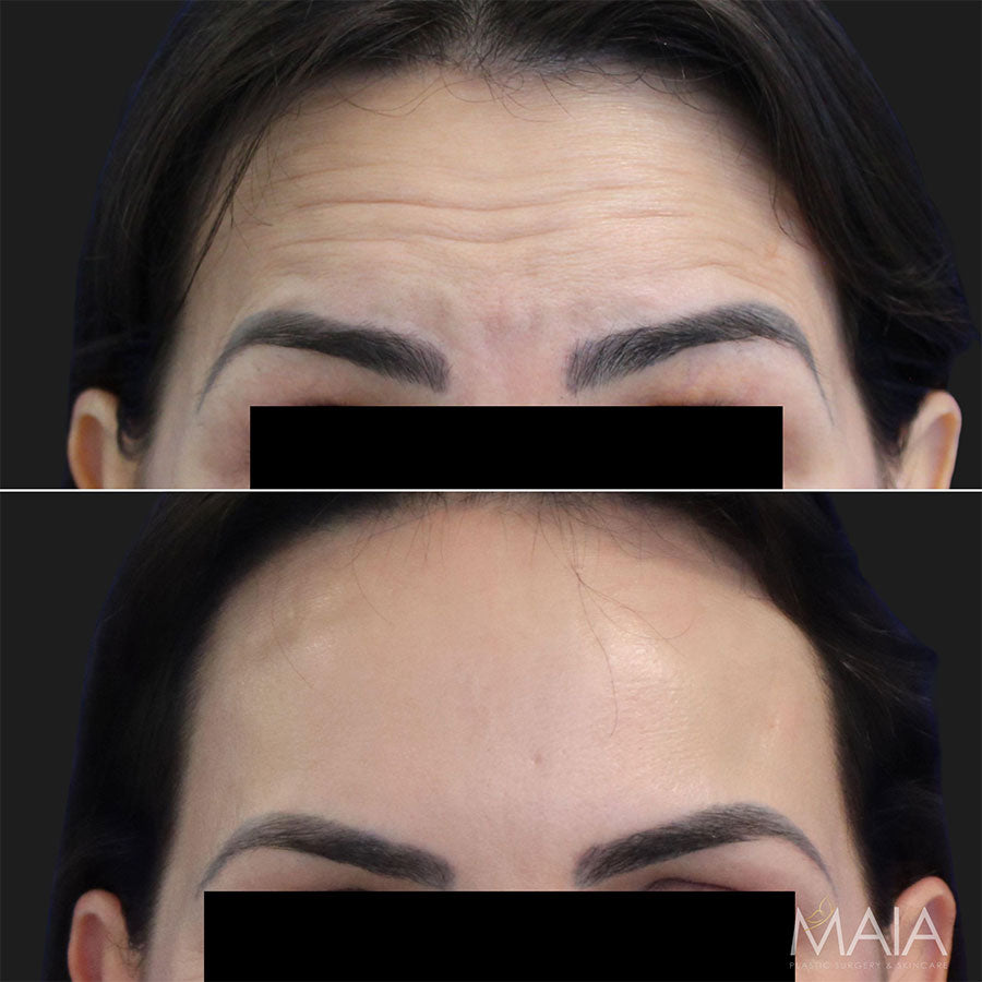 Unit of BOTOX - Bank Your Botox with Dr. Maia -Feb 9th to 14th ONLY